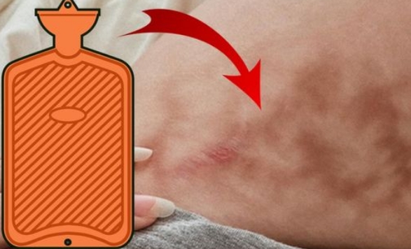 Toasted-Skin-Syndrom: Hautprobleme durch Wärmflasche
